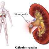 Cálculos renales de riñón - Médico Urólogo en Salamanca