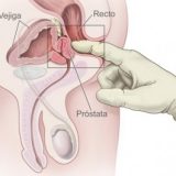 Hiperplasia Benigna de Próstata - urólogo en Salamanca